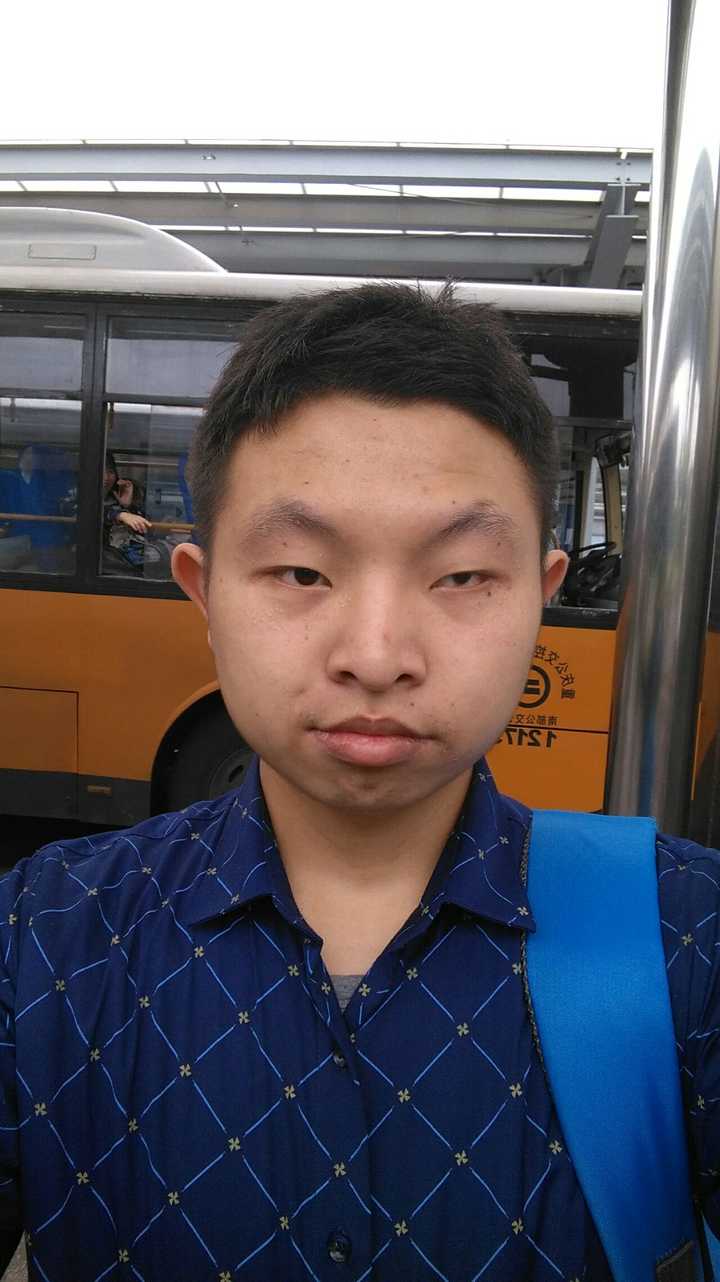 单眼失明是种怎样的体验?