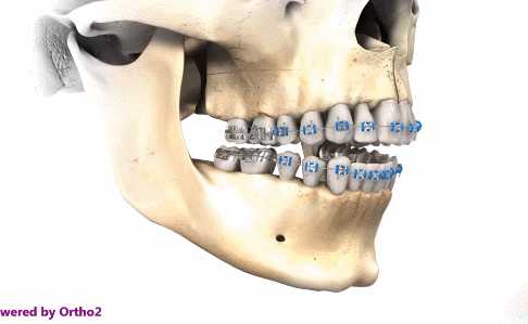 联合治疗后,她颌面变得更加接近直线型,同时牙齿也没那么突出了.