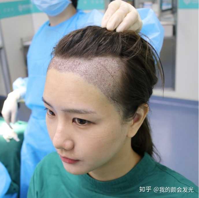 我这种发际线植发要多少钱