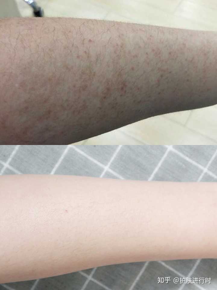 遮瑕可以遮住腿上的鸡皮肤(遮瑕可以遮住腿上的鸡皮肤嘛)