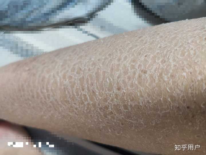 得了鱼鳞病是一种怎样的体验 知乎