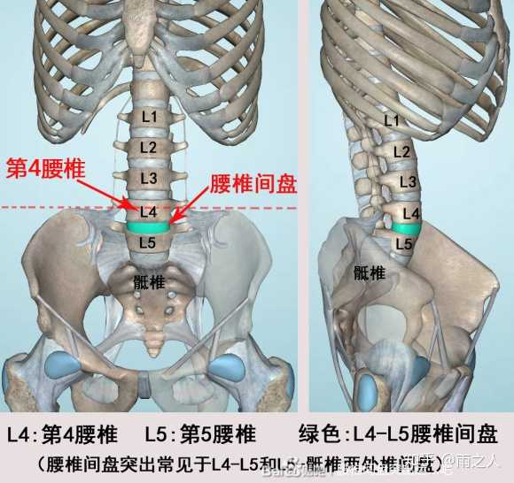 大多数腰突病患者因为突出物对神经根的招惹