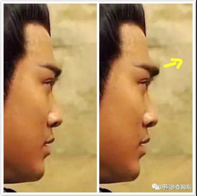 隆眉弓手术安全稳定吗 技术是不是没有隆鼻手术成熟 有什么副作用 知乎