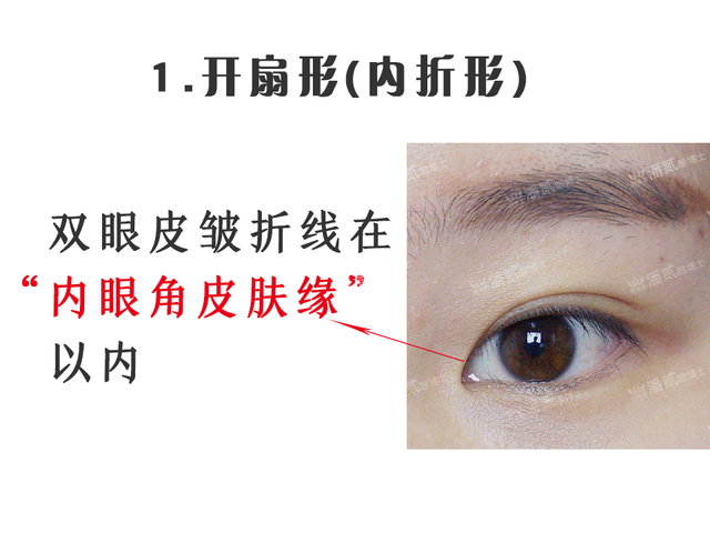 根据内眦赘皮的多少,也就说双眼皮皱折线与内眼角皮肤缘的位置关系