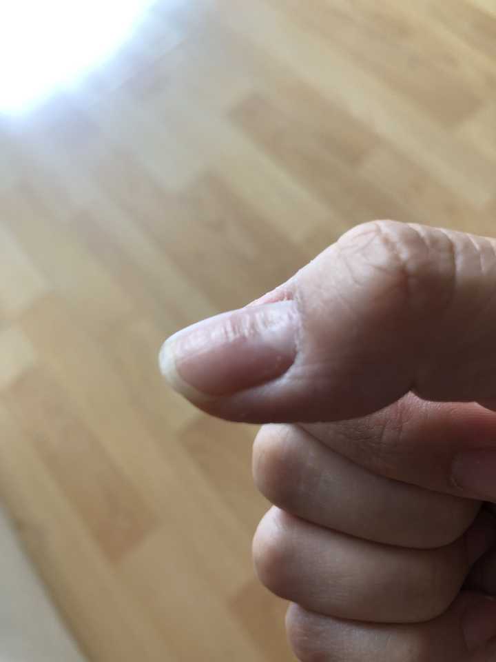 大拇指指甲凹凸不平 有凸起的横纹和凹陷 很多年了也没有其它问题 去检查也不知道应该去哪个科室 知乎