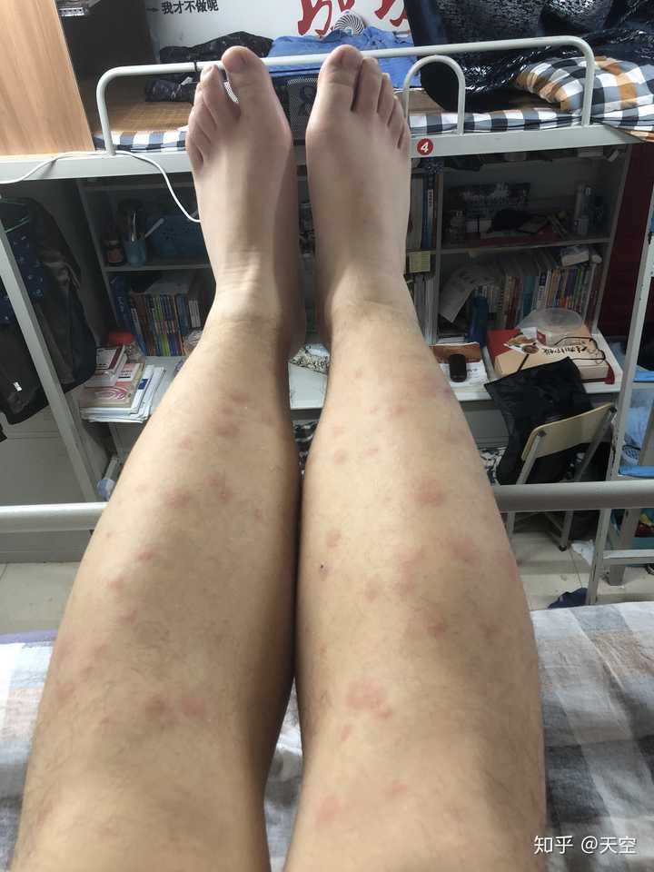 夏天被蚊子咬是什么样的体验?