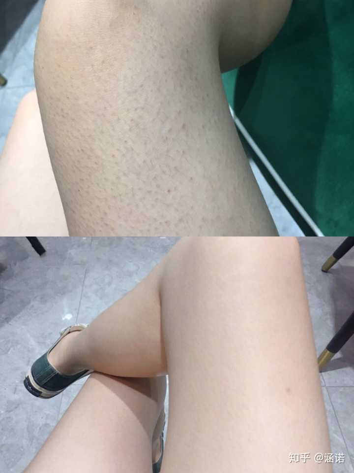去角质有必要吗 知乎 去角质有必要吗 知乎