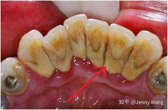 牙齿根部发黄腐蚀图片图片