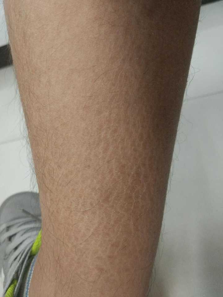 鱼鳞病患者如何保养皮肤 知乎 鱼鳞病患者如何保养皮肤 知乎