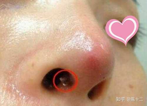 虽说膨体的感染率比较低,可一旦发生感染就是百分之百了 如果发生感染