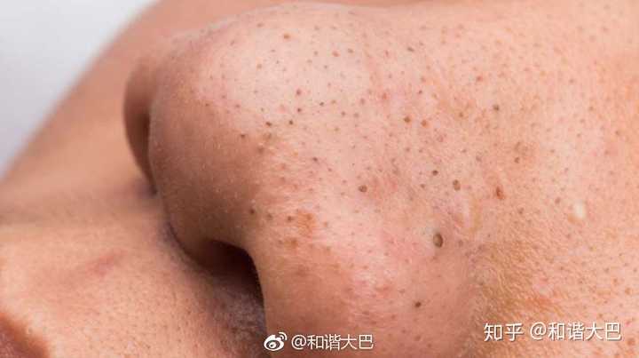 如何正确有效的去掉鼻子上的黑头 知乎