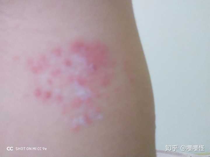 得了带状疱疹的症状及感受是什么 知乎 得了带状疱疹的症状及感受是什么 知乎