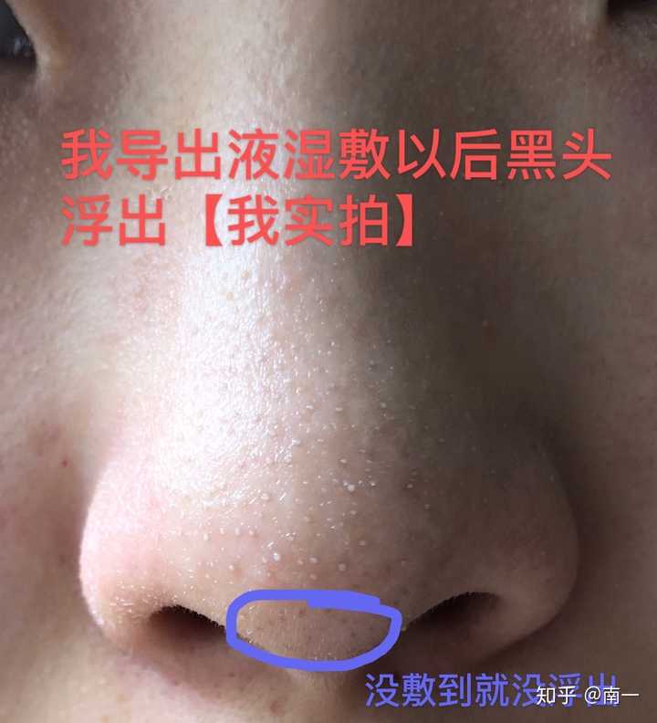 如何去除鼻子上的黑头 知乎