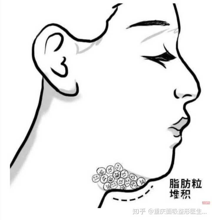 有什么办法减掉双下巴呢?