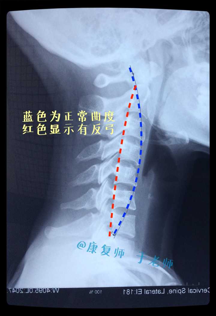 颈椎病可以恢复吗 知乎