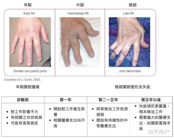 「类风湿关节炎」病因是什么，有哪些临床表现，如何有效预防或治疗？ 知乎