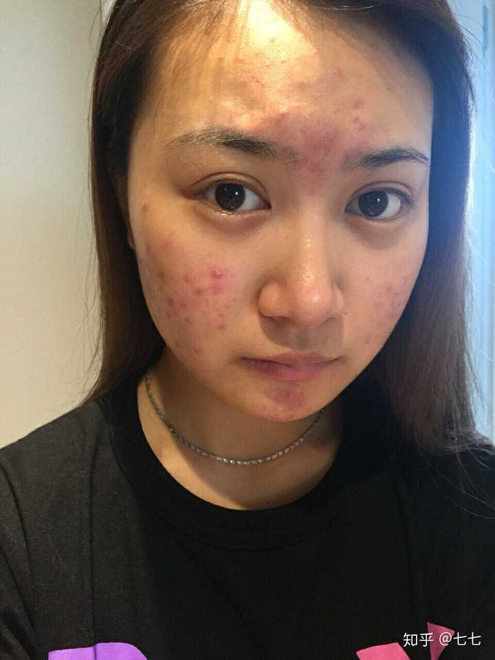 长过痘痘的脸如何恢复白皙