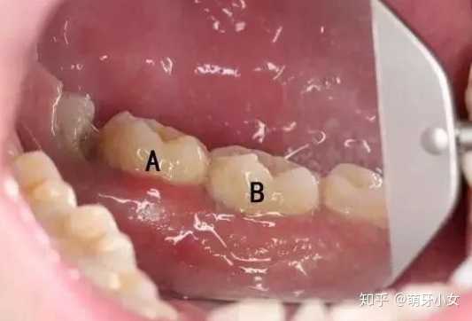 牙龈炎该怎么治疗？
