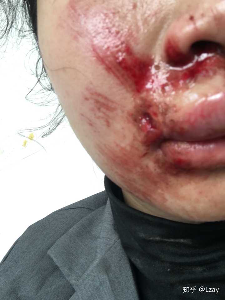 脸部大面积擦伤,伤口较深要注意什么?