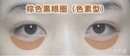 我这种黑眼圈真的让我绝望 怎么办 知乎 我这种黑眼圈真的让我绝望 怎么办 知乎