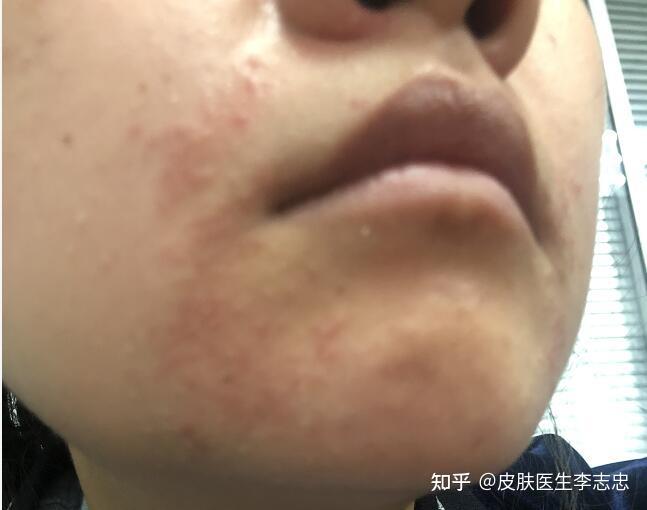 皮肤医生李志忠 的想法【口周湿疹医案分享 黄某,女,8岁,患