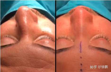 鼻子歪怎么办 知乎