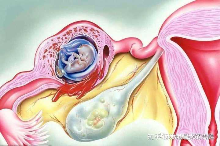 受精卵正常着床 受精卵异常着床—— 宫外孕(着床于输卵管) 后期胚胎