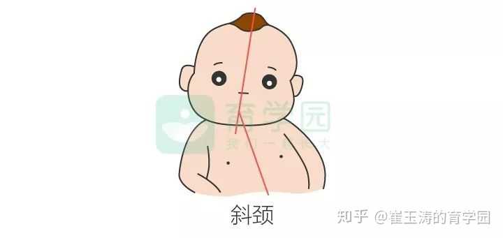 二呢,就是出生后形成的 姿势性的斜颈,虽然这种情况下肌肉并没有受伤
