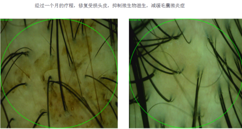 很多人都喜欢抠头皮上的颗粒 到底是啥东西 知乎