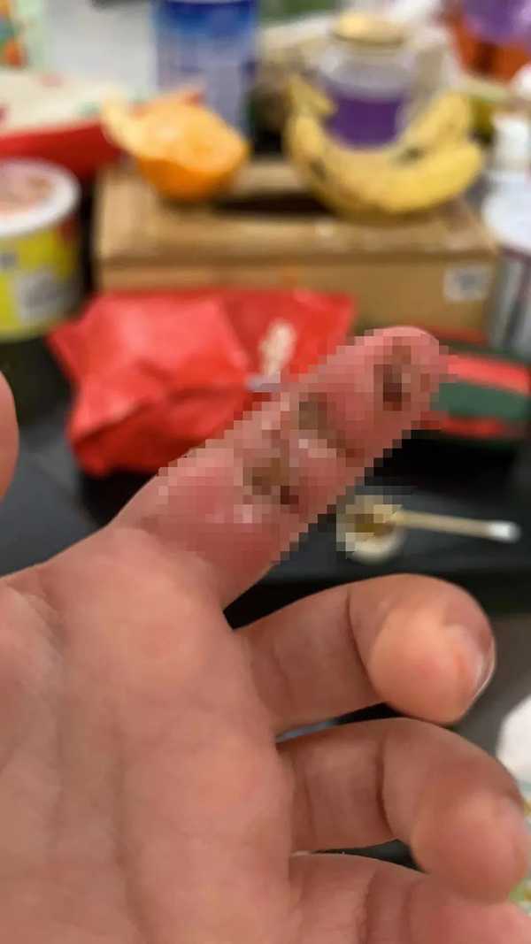 兄弟俩总乱咬，有自残倾向，确诊自毁容貌综合征，这是种什么病？能治吗？