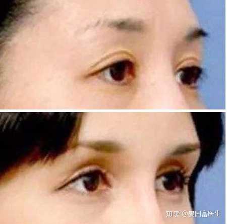 隆眉弓手术安全稳定吗 技术是不是没有隆鼻手术成熟 有什么副作用 知乎