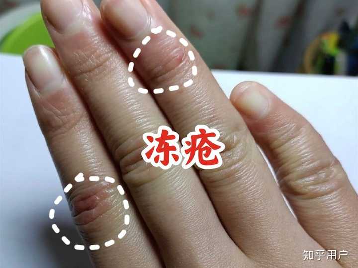 为什么每到冬天手背都会开裂? - 知乎
