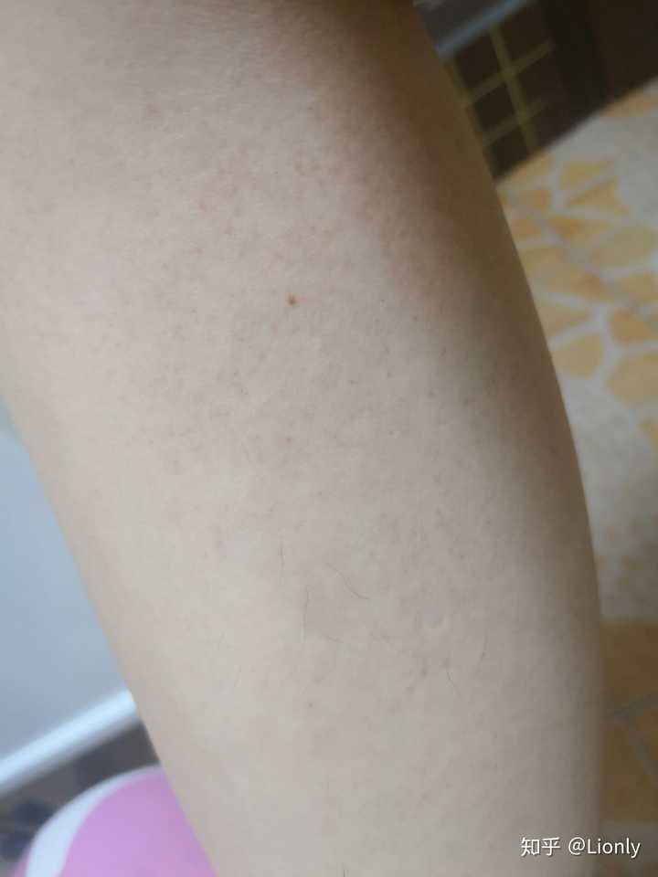 激光脱毛后色素沉着 知乎 激光脱毛后色素沉着 知乎