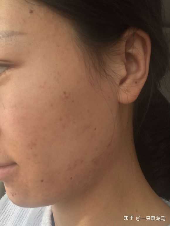 痘痘肌真的不适合喝牛奶吗？