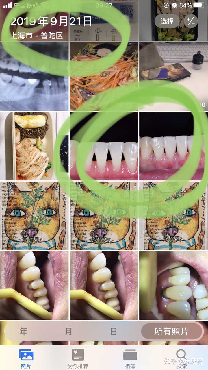 牙龈萎缩照片图片