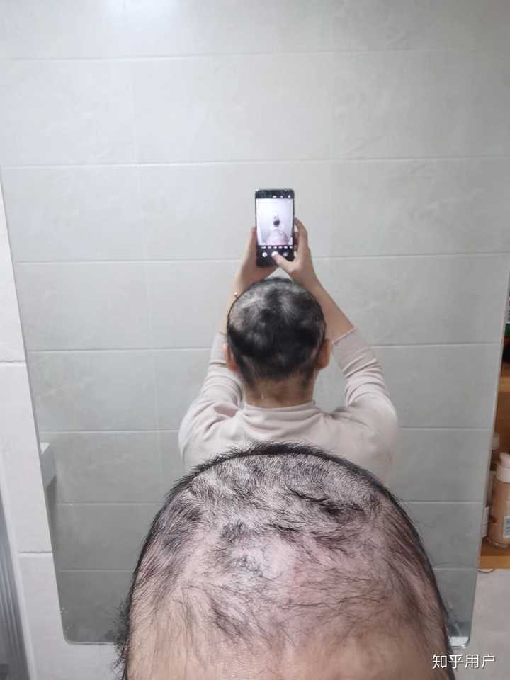 我一个斑秃,全秃的患者!我心态崩了吗?
