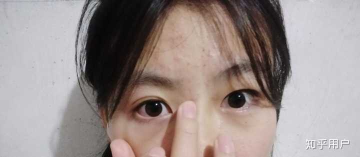 割双眼皮是一种什么样的体验?