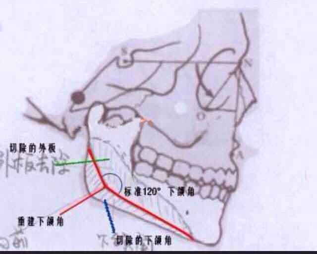 下颌角再造式切法