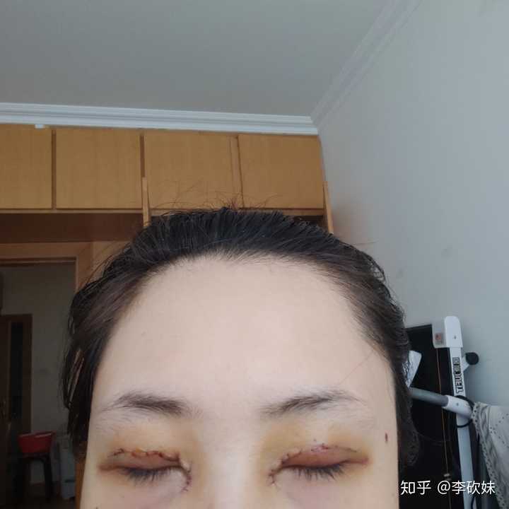 割双眼皮是种怎样的体验?