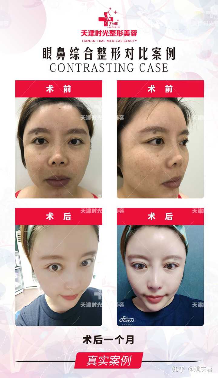 我这种鼻子是朝天鼻吗?