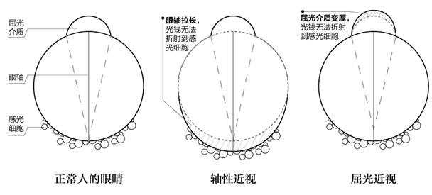 眼軸增長導致近視,角膜曲率導致近視 這是從眼球結構改變來說的,而