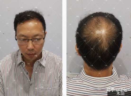 植发大概需要多少钱 知乎 植发大概需要多少钱 知乎