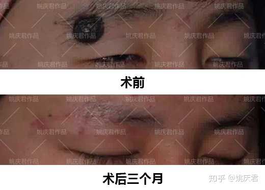 一般切除痣后,精细的美容缝合能让眼睑皮肤上的疤痕仅呈细线样.