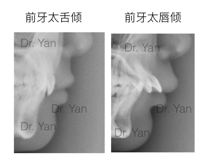 標準的牙齒咬合到底是什麼樣的?