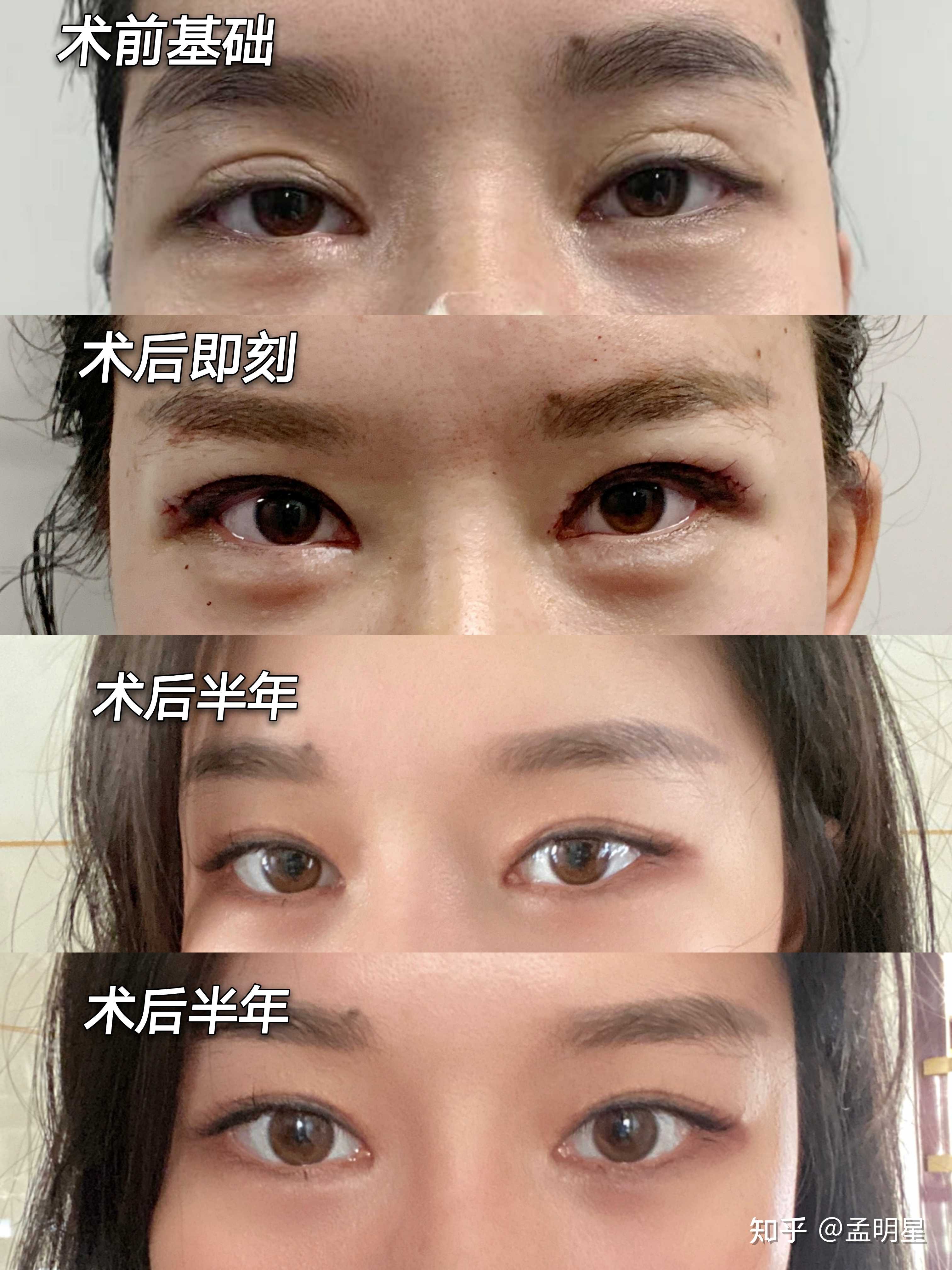 双眼皮修复s后半年反馈效果