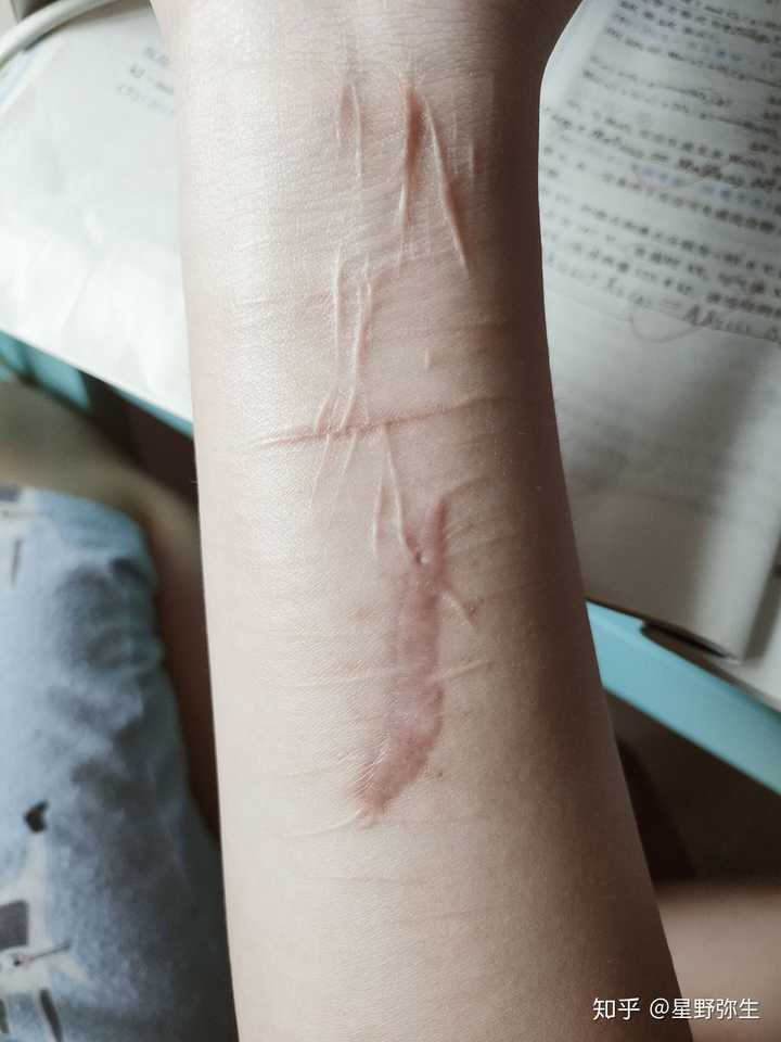 手腕割伤疤痕图片