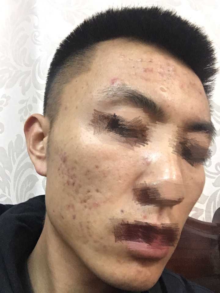 有没有治疗青春痘特别有效的药物或方法？