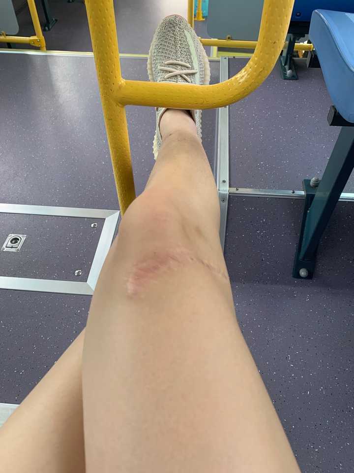 夏天那些腿上有疤并且敢于穿短裙的女生,是什么样的女生,?