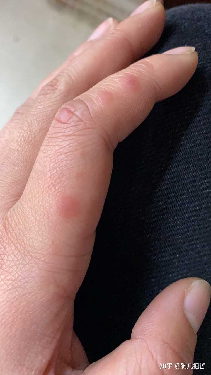 手上长水泡又疼又痒