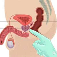 距離肛門口約5cm,在膀胱與尿生殖膈之間,前列腺上端和膀胱頸,精囊腺